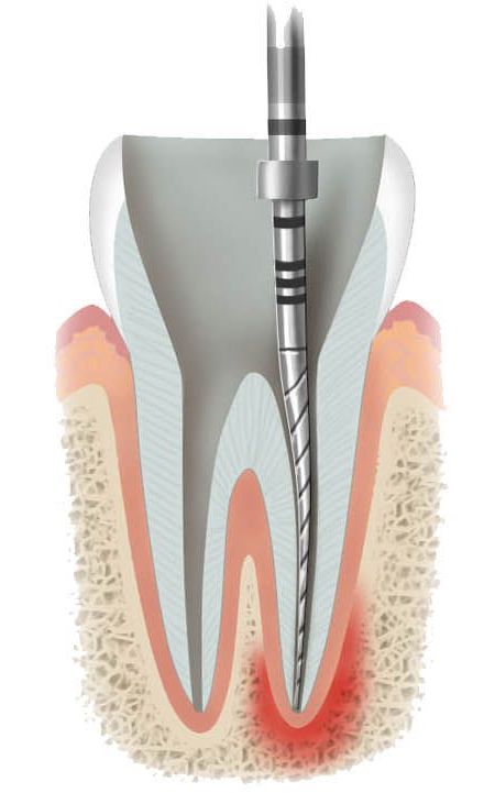 endodonzia2